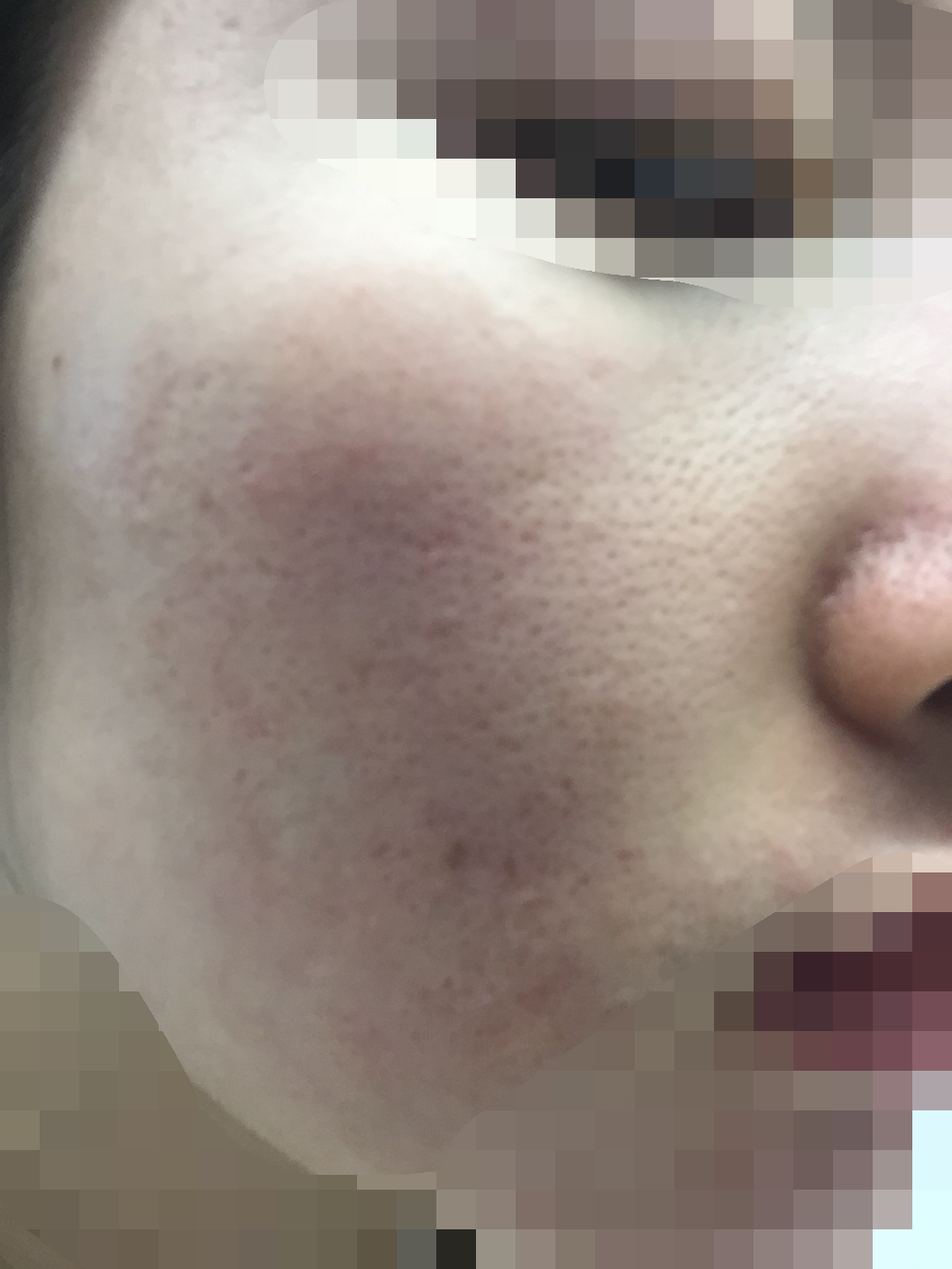 【爆照】求助,脸部泛红,毛孔粗.