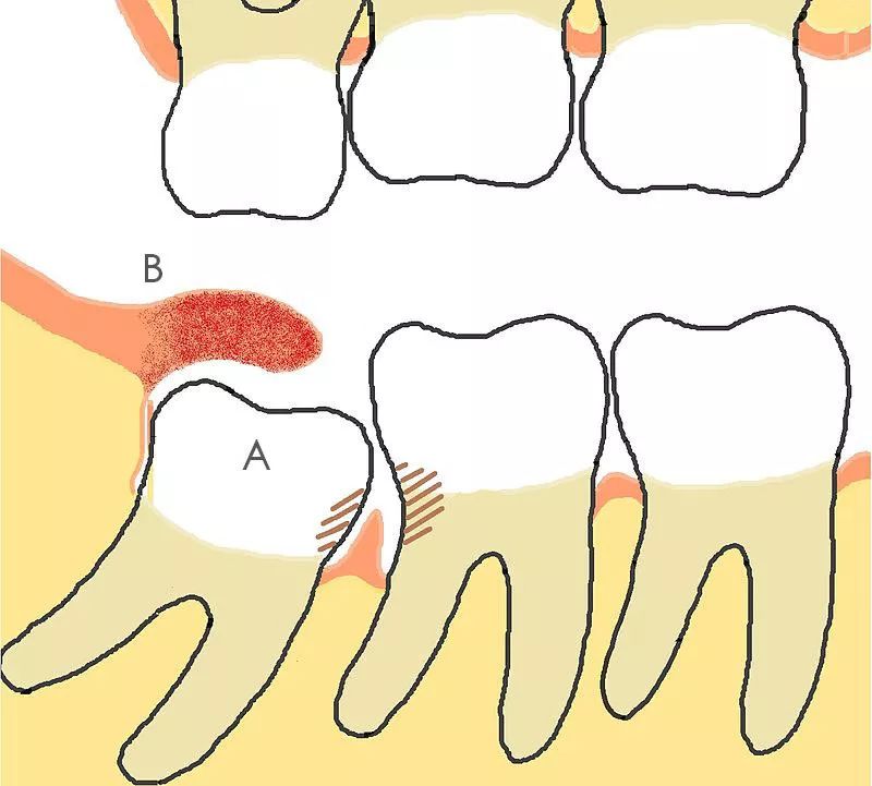 a处为智齿,b处为牙冠与牙龈形成的盲袋丨wikipedia