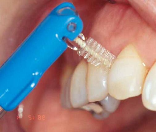 对于新的指南提到的牙间隙刷,很多人并不了解,在控制牙周病方面,牙
