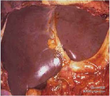 我们先从肉眼观看看正常肝脏与三种疾病时肝脏的区别,很容易的,不用
