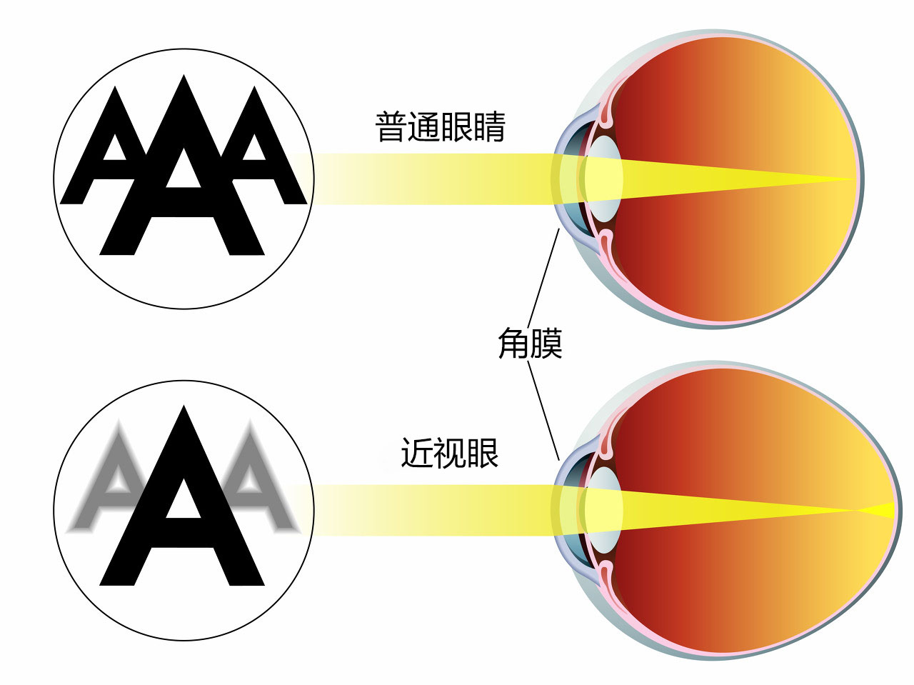 正常视力者和近视者的屈光成像对比.图片来源:图虫创意