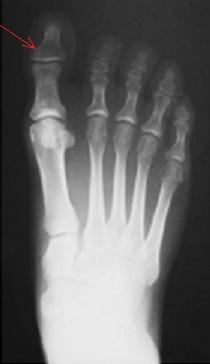 大脚趾戳了,医生说是肌腱损伤.戳脚趾为什么肌腱会伤呢?