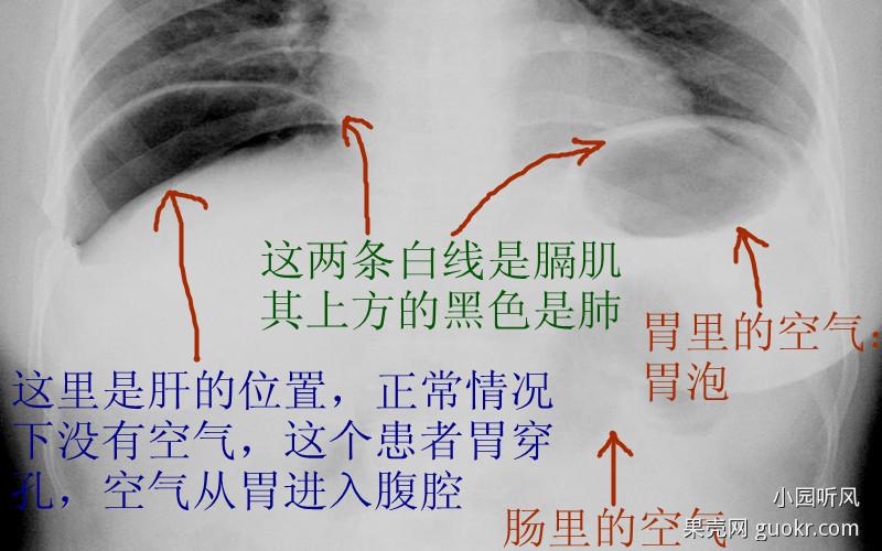 1,用听诊器可以听到肠鸣音,肠鸣音是胃肠蠕动时里面的空气和液体被