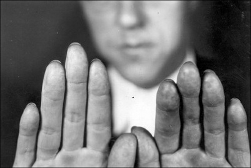 卡尔皮斯在被捕时展示自己没有指纹的手指。