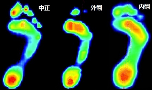 中正、外翻和内翻的脚的足底压力分布，红色压强最大，其次是黄绿蓝。