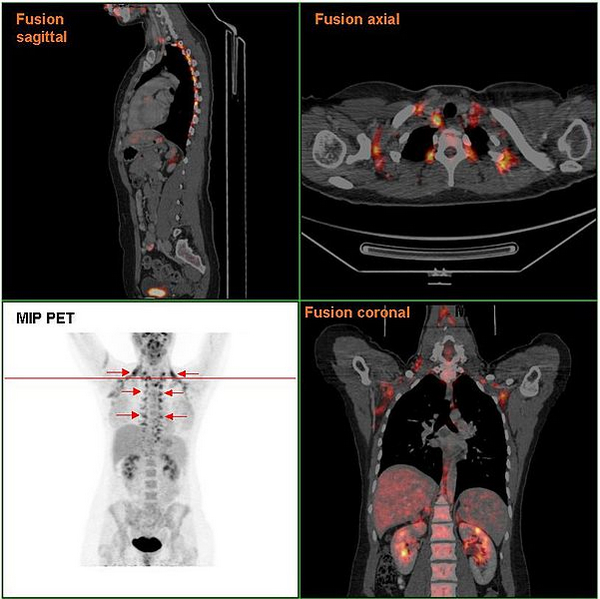 女性棕色脂防组织分布的PET/CT 扫描结果图。图片：http://en.wikipedia.org/wiki/File:Brownfat_PETCT.jpg。