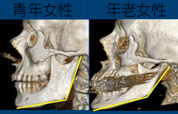 青年女性与年老女性面部骨骼对比图。年老女性面部骨骼明显下垂。图片来自：http://www.urmc.rochester.edu/news/story/index.cfm?id=2800。