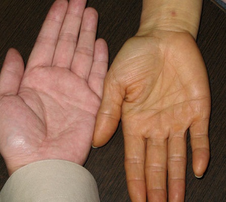 右边那只手出现了胡萝卜素血症的症状/dr-skin.com.tw