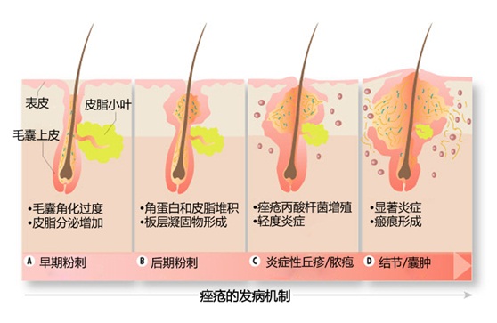 该图显示痤疮发展的4个阶段。图片来自http://www.healingrosacea.com/acne-vulgaris/。