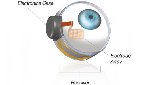新的实验中，研究者们绕过了摄像头，直接激活了受试者视网膜上的6个电极