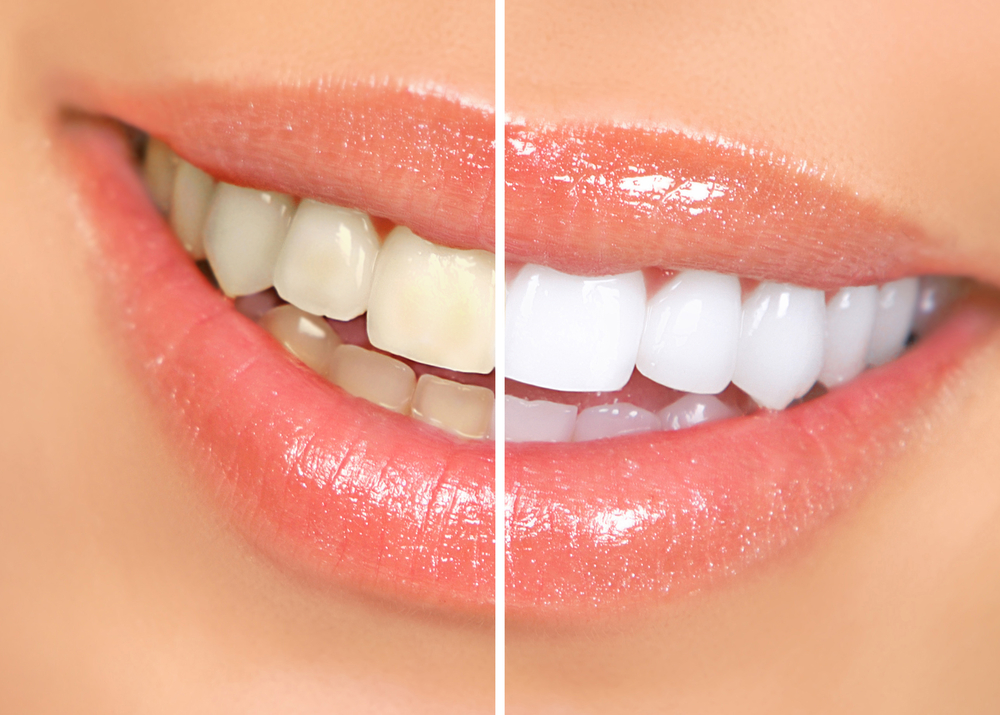 牙齿漂白后笑容迷人，漂白剂引起的牙齿敏感、酸痛却不容忽视
