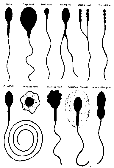 如图，只有左上角的那一个是普通精子，其他的长得可不只是文艺那么简单…… (http://www.ivf.com)